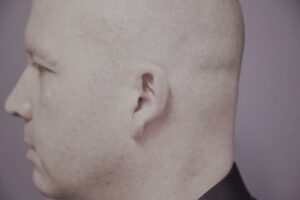 Lyric - 24/7 Hidden Hearing Aid